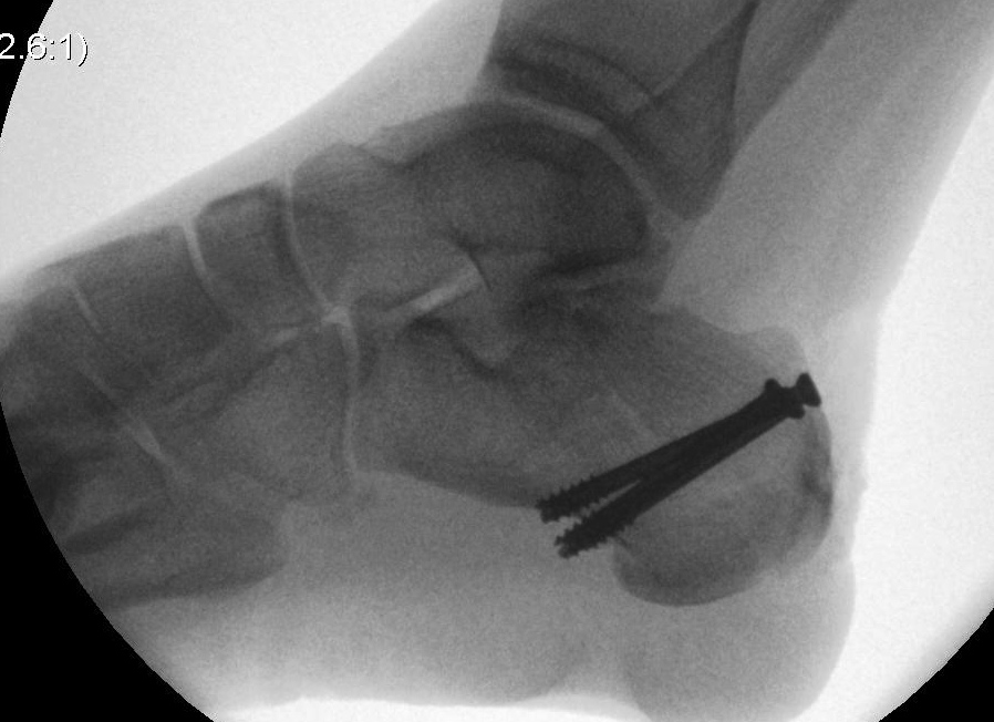 Calcaneum Fracture Tongue Type ORIF